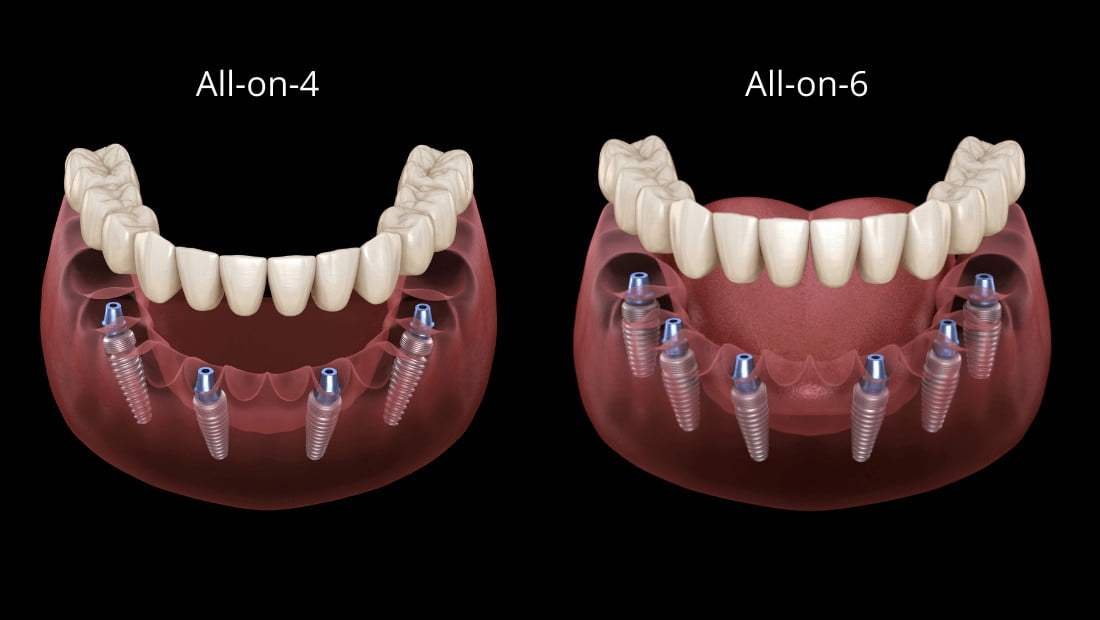 tecnica-All-On-4-e-All-On-6-a-carico-immediato-3 tecnica-All-On-4-e-All-On-6-a-carico-immediato-3