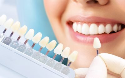 Faccette estetiche dentali