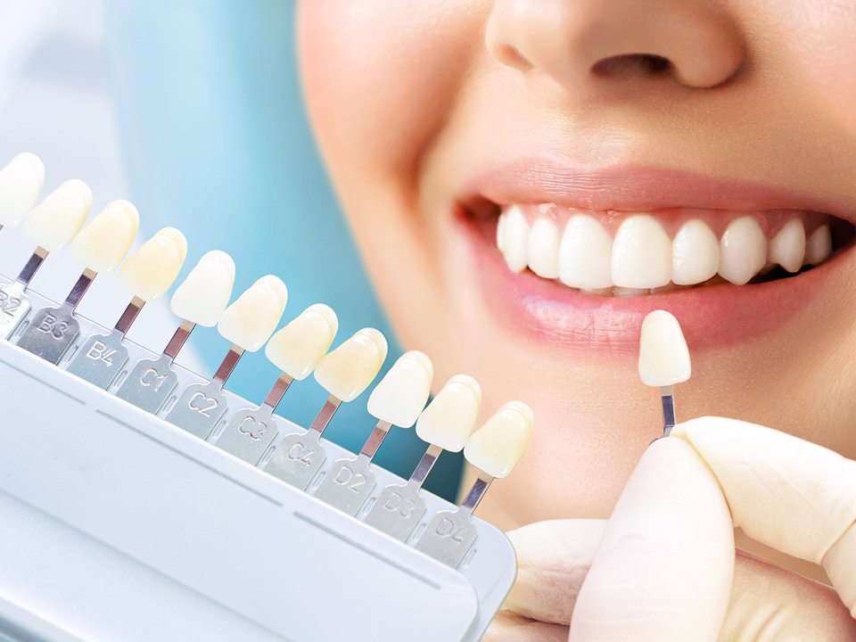 Faccette estetiche dentali Faccette estetiche dentali