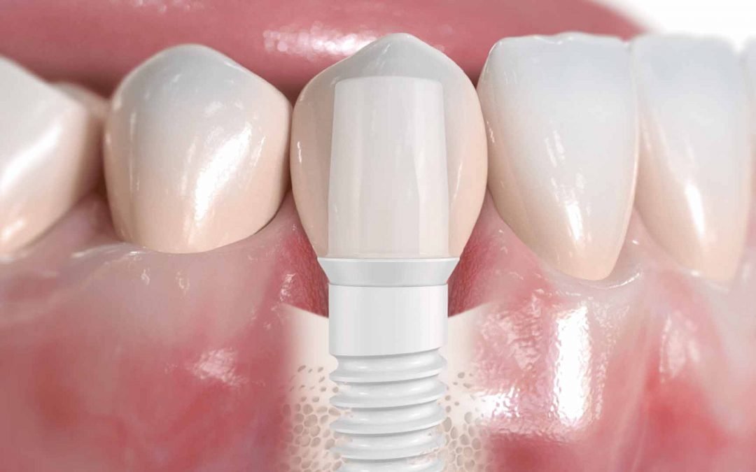 Implantologia generale – Implantologia a carico immediato