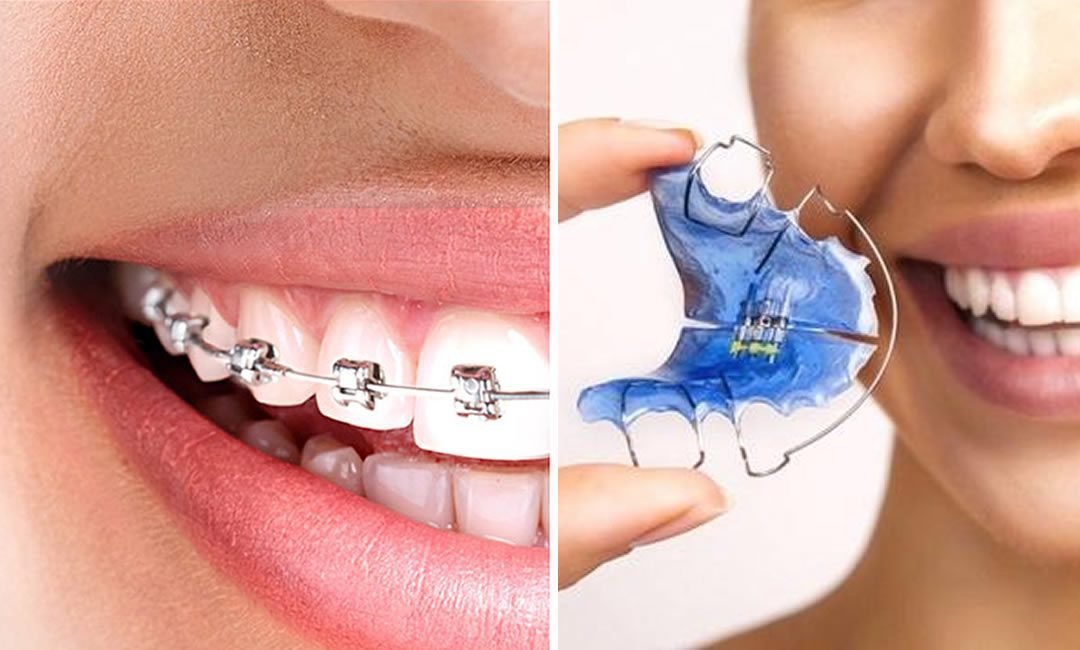 Ortodonzia e Ortodonzia intercettiva