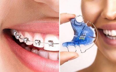 Ortodonzia e Ortodonzia intercettiva