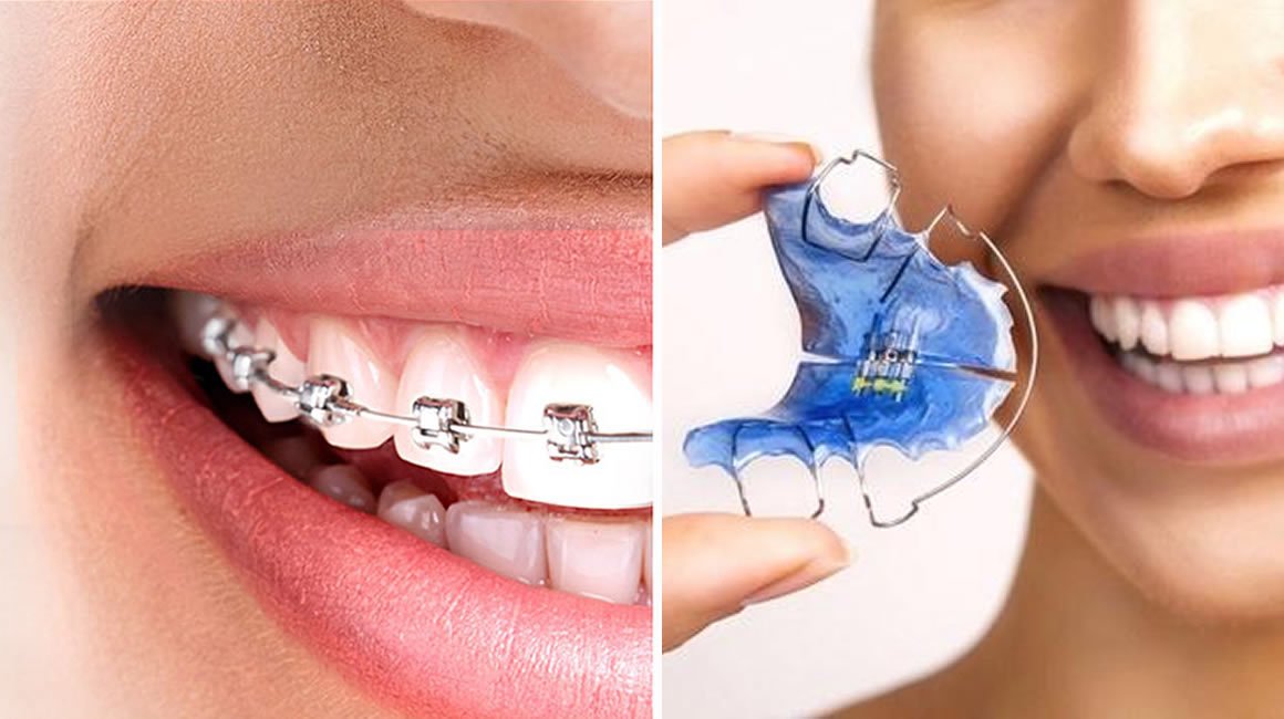 Ortodonzia e Ortodonzia intercettiva