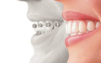 Ortodonzia estetica e invisibile