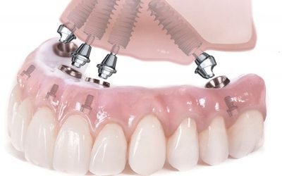 Tecnica all on 4 – all on 6 a carico immediato