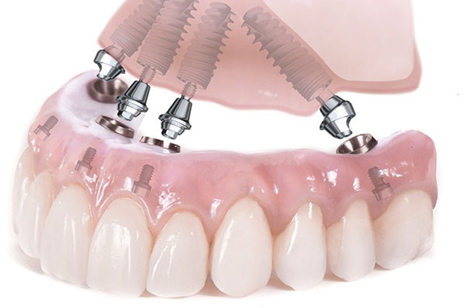 Tecnica all on 4 – all on 6 a carico immediato